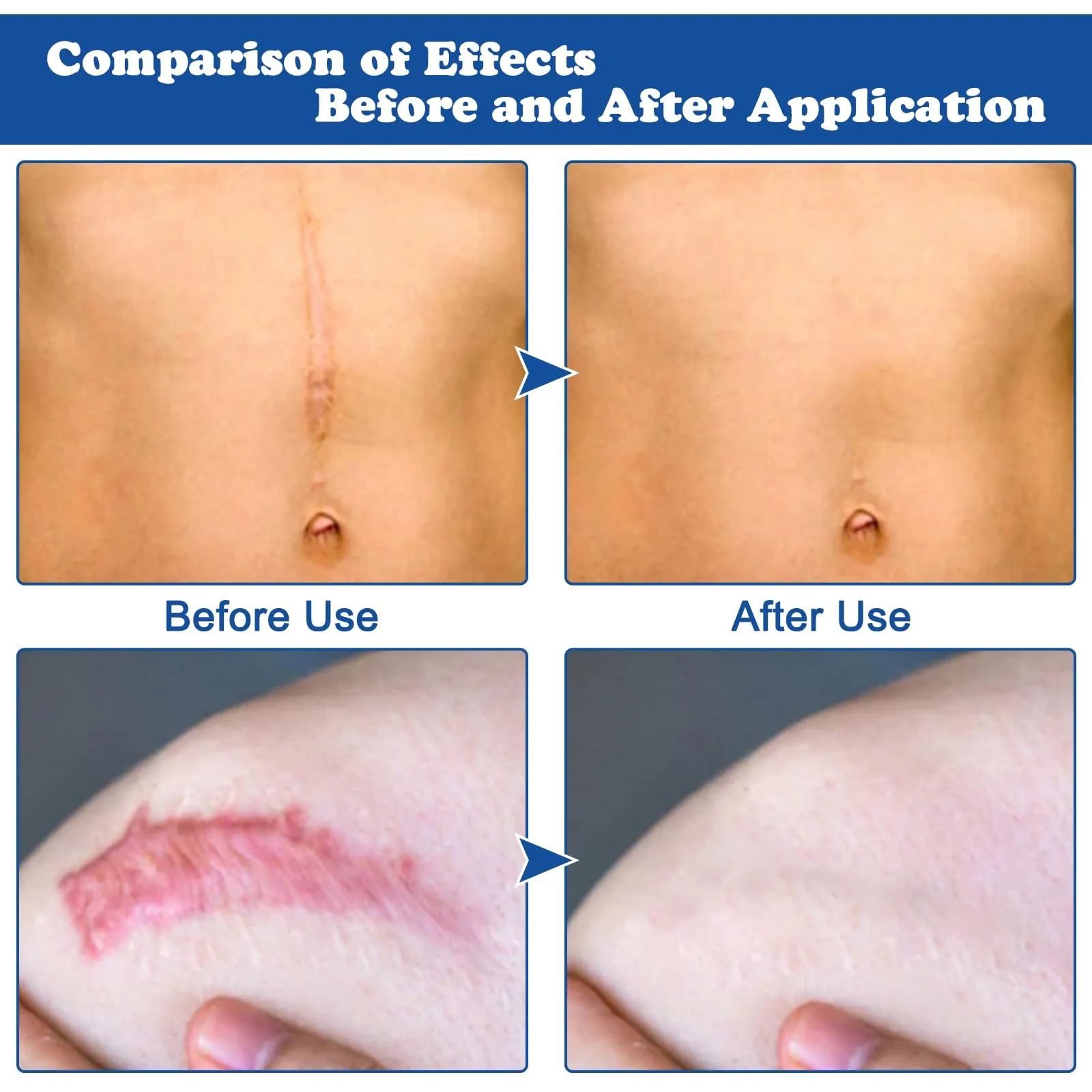 2 sticks of scar ointment, scar gel, scar cream, scar gel, scar cream after surgery, scar gel after surgery, scar ointment after surgery, scar gel for children and adults, scar ointment after surgery