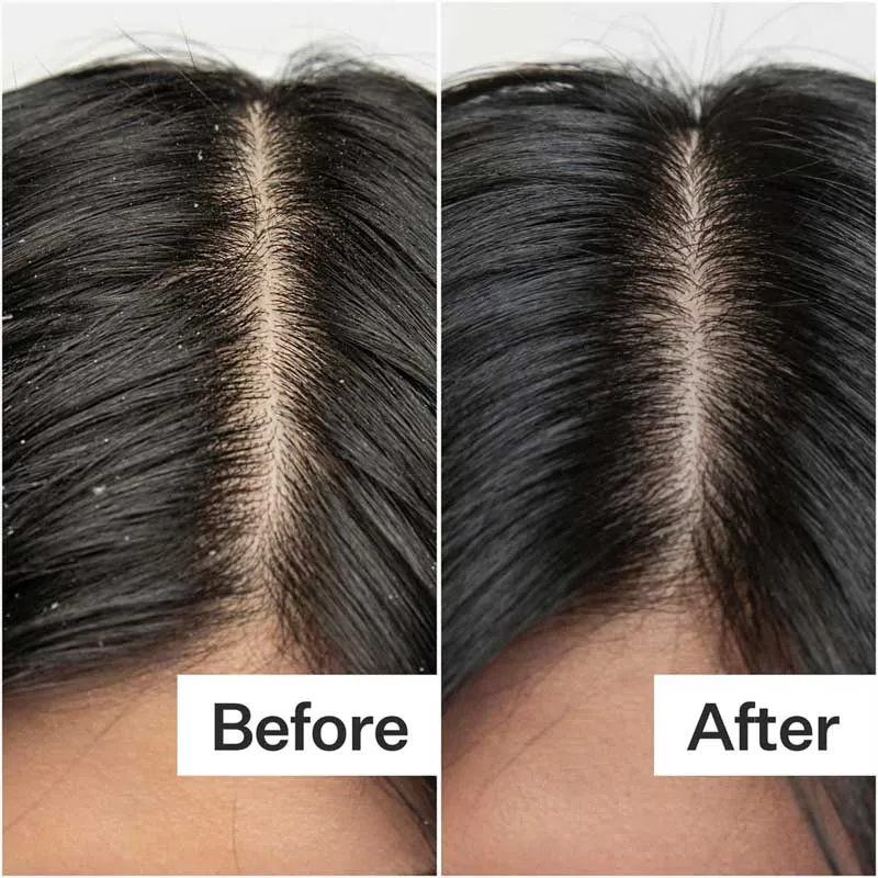 Act Acre Dry   Itchy Scalp System