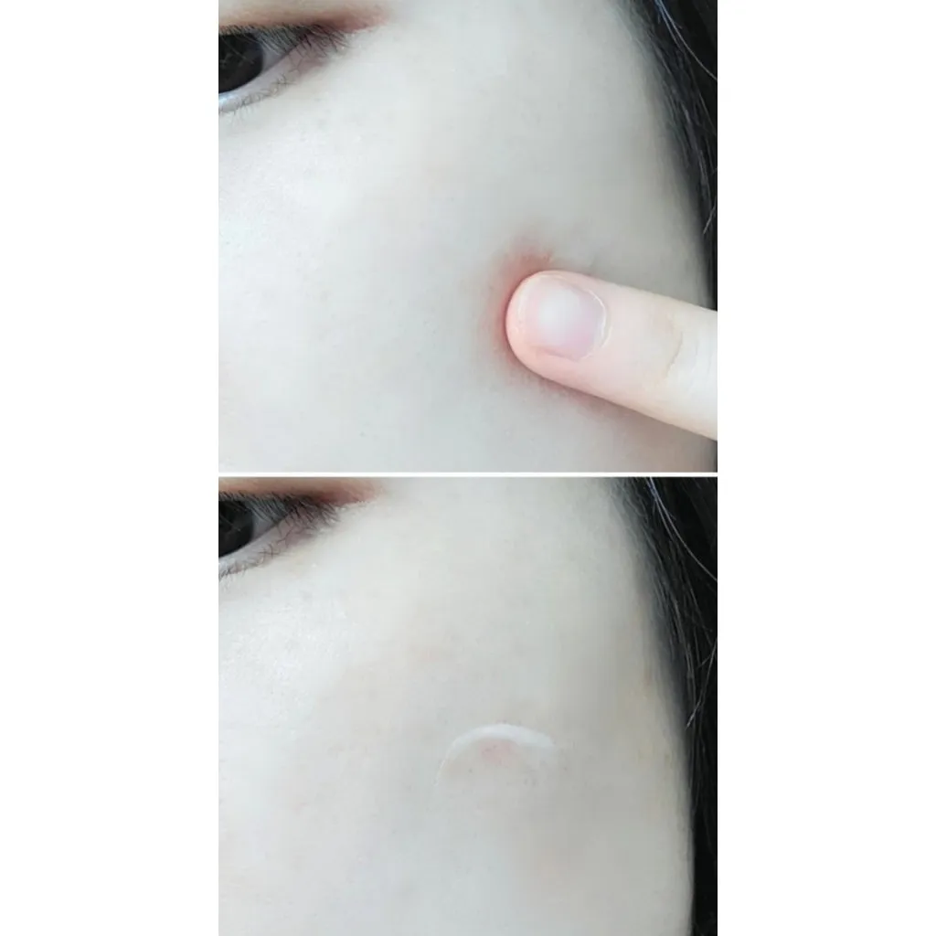 DONG-A Noscarna Gel 20g/pack Acne scars, Hypertrophic Keloid Scars, Surgical Scar Care / from Seoul, Korea