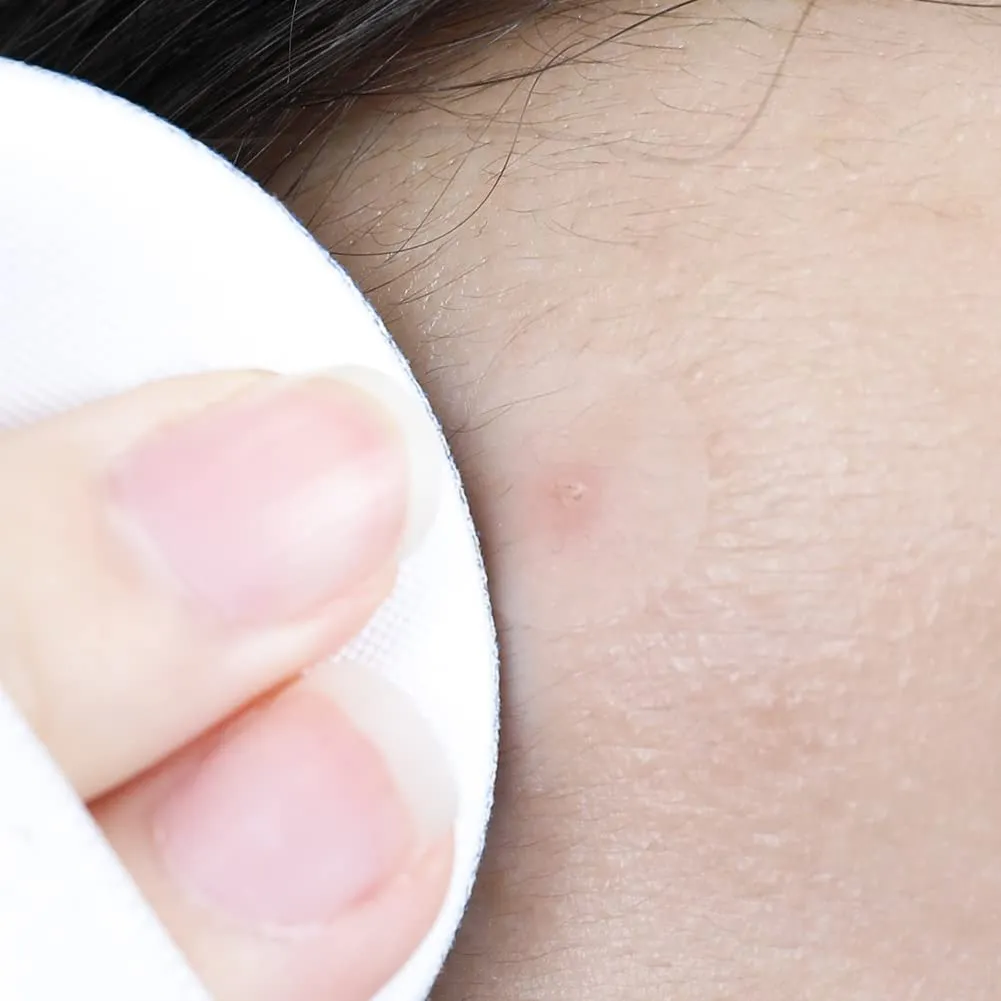 ELIZAVECCA ac guard spot patch لصقات تهدئة التهيج من اليزافيكا