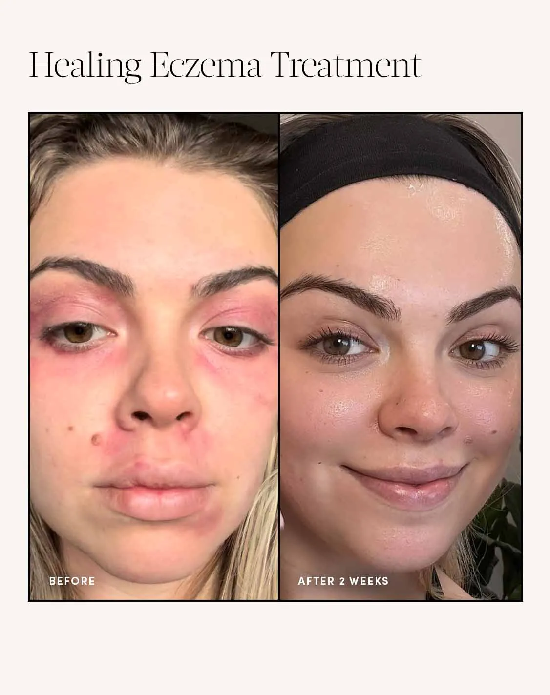 Healing Eczema Treatment