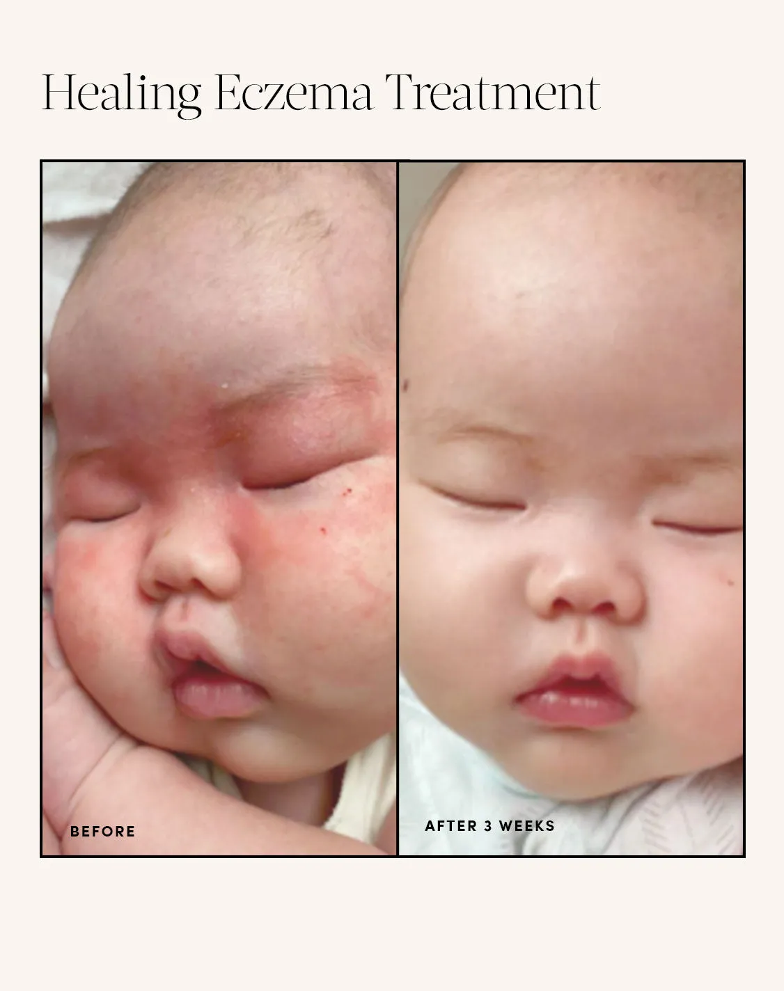 Healing Eczema Treatment