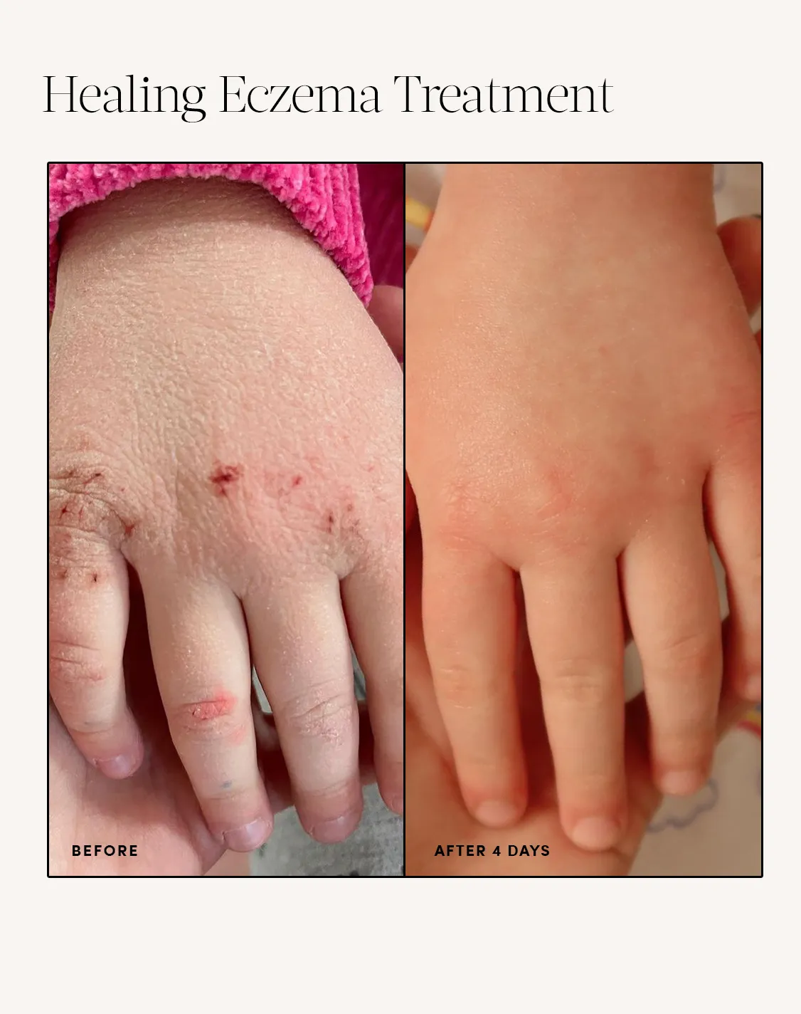 Healing Eczema Treatment