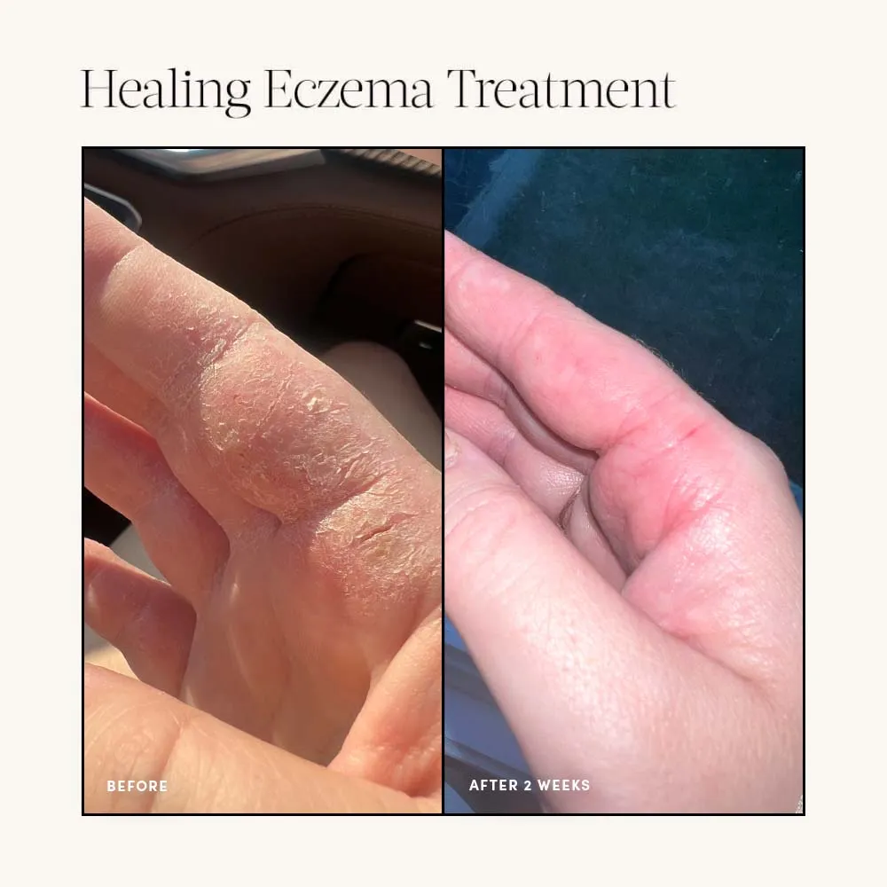 Healing Eczema Treatment