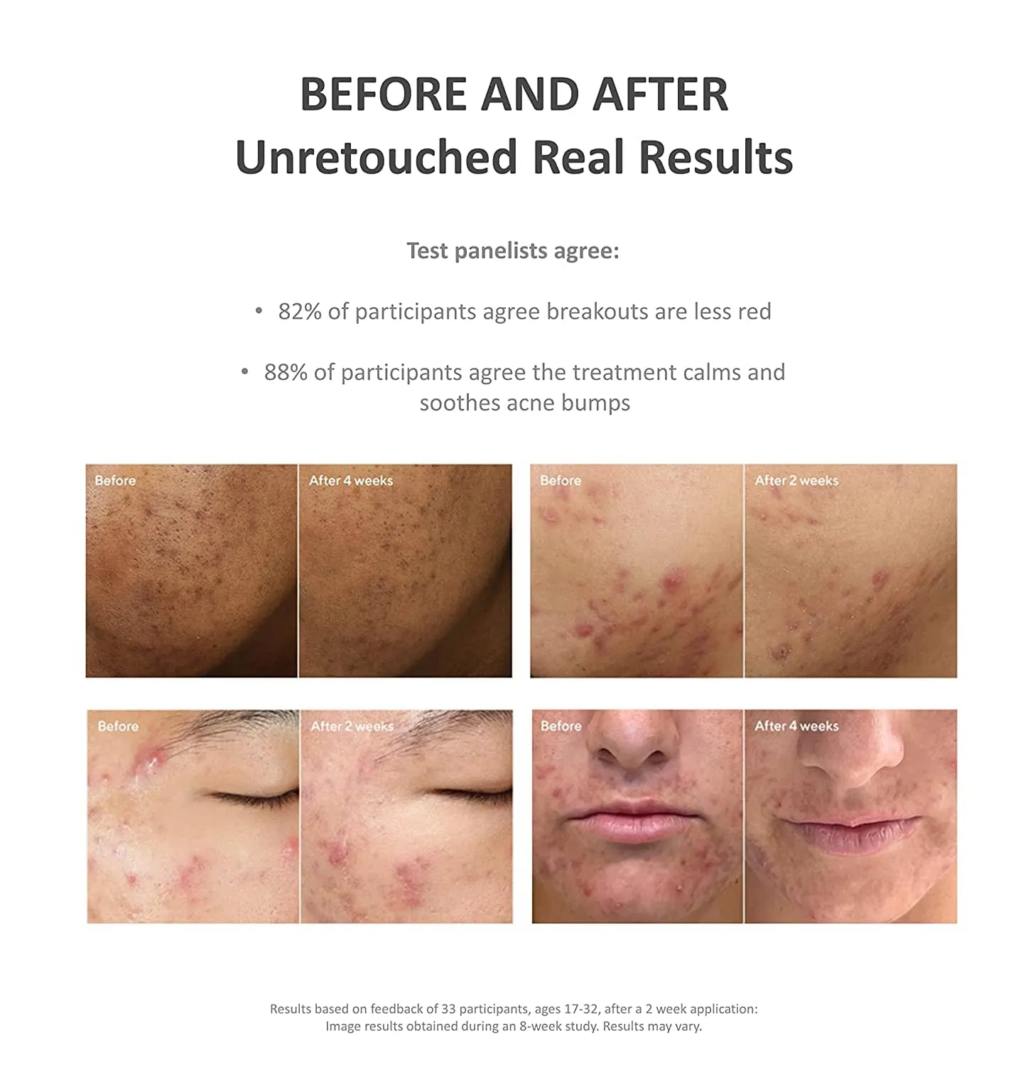 Murad Deep Relief Acne Treatment with 2% Salicylic Acid