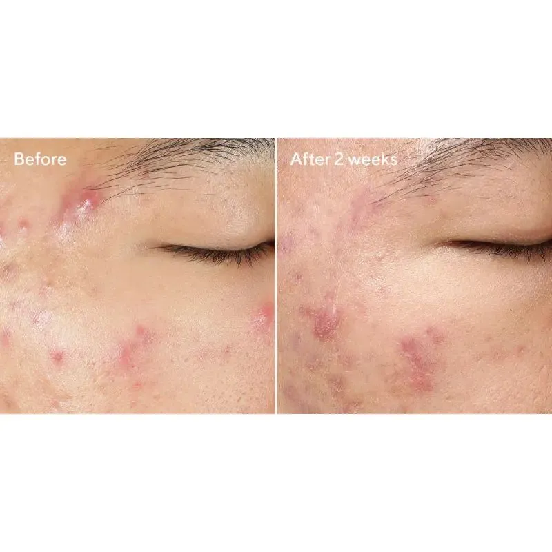 Murad Deep Relief Acne Treatment
