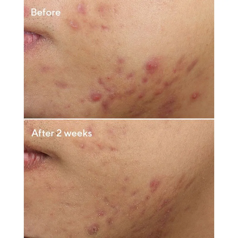 Murad Deep Relief Acne Treatment