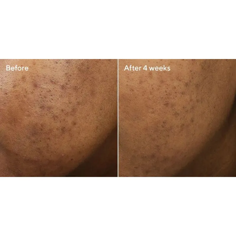 Murad Deep Relief Acne Treatment