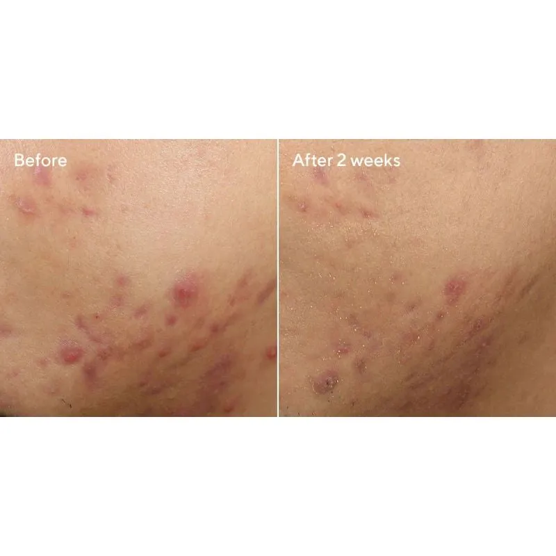 Murad Deep Relief Acne Treatment