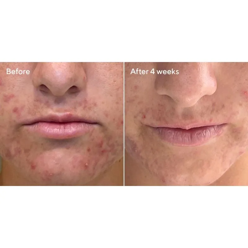Murad Deep Relief Acne Treatment