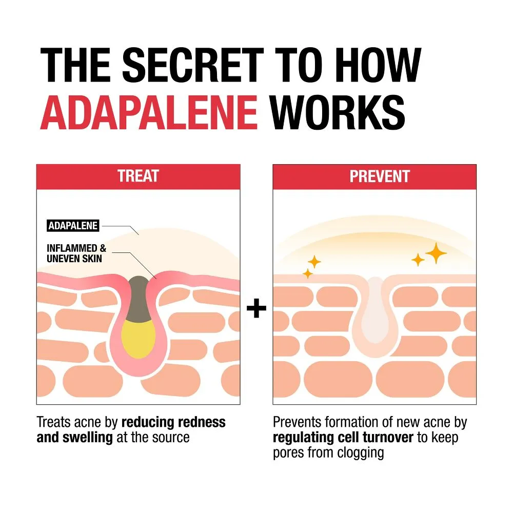 New - Neutrogena Stubborn Acne Adapalene Gel with 0.1% Adapalene Acne Treatment - 1.6oz