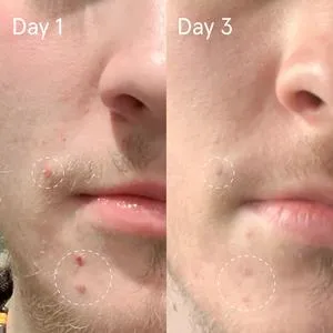 Sulfur Spot Treatment