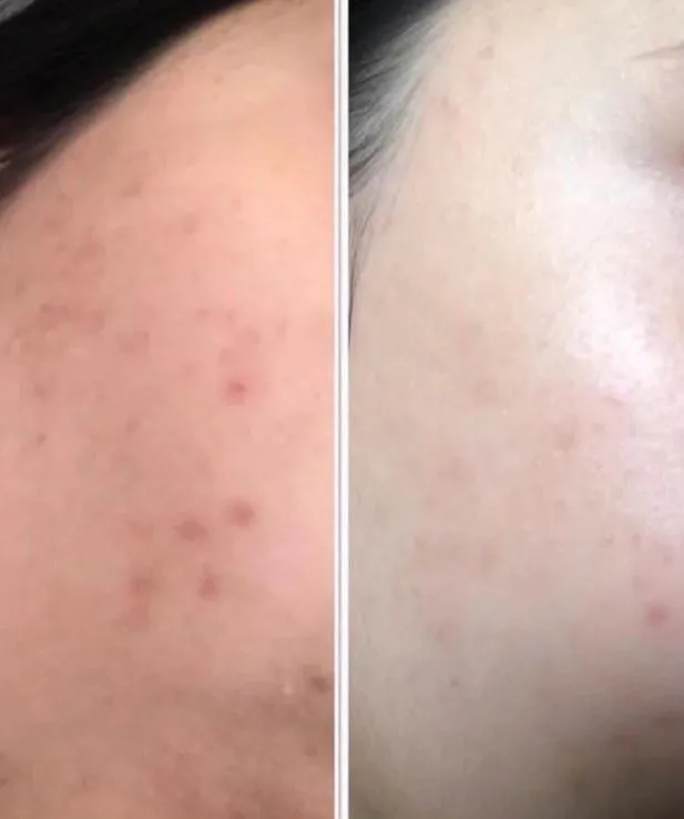 Tanash Beauty Spot Gel Acne Treatment