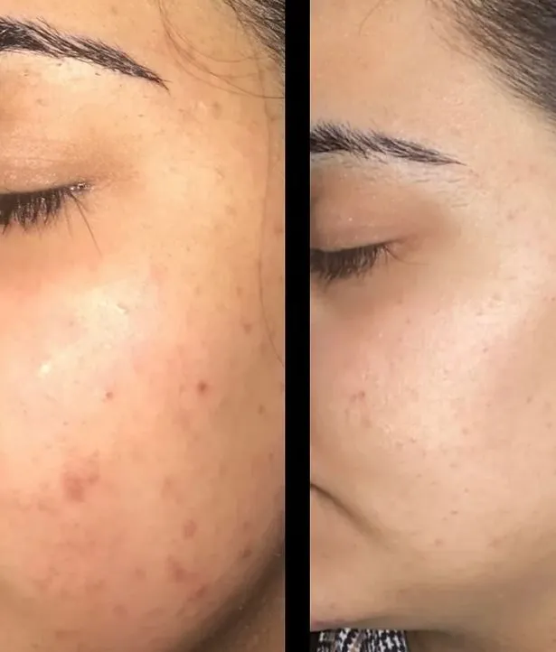 Tanash Beauty Spot Gel Acne Treatment