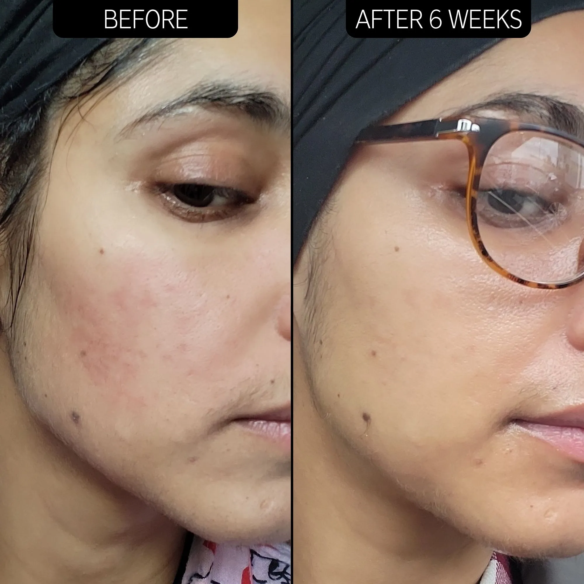 THE INKEY LIST SUPER SOLUTIONS 10% AZELAIC ACID SERUM